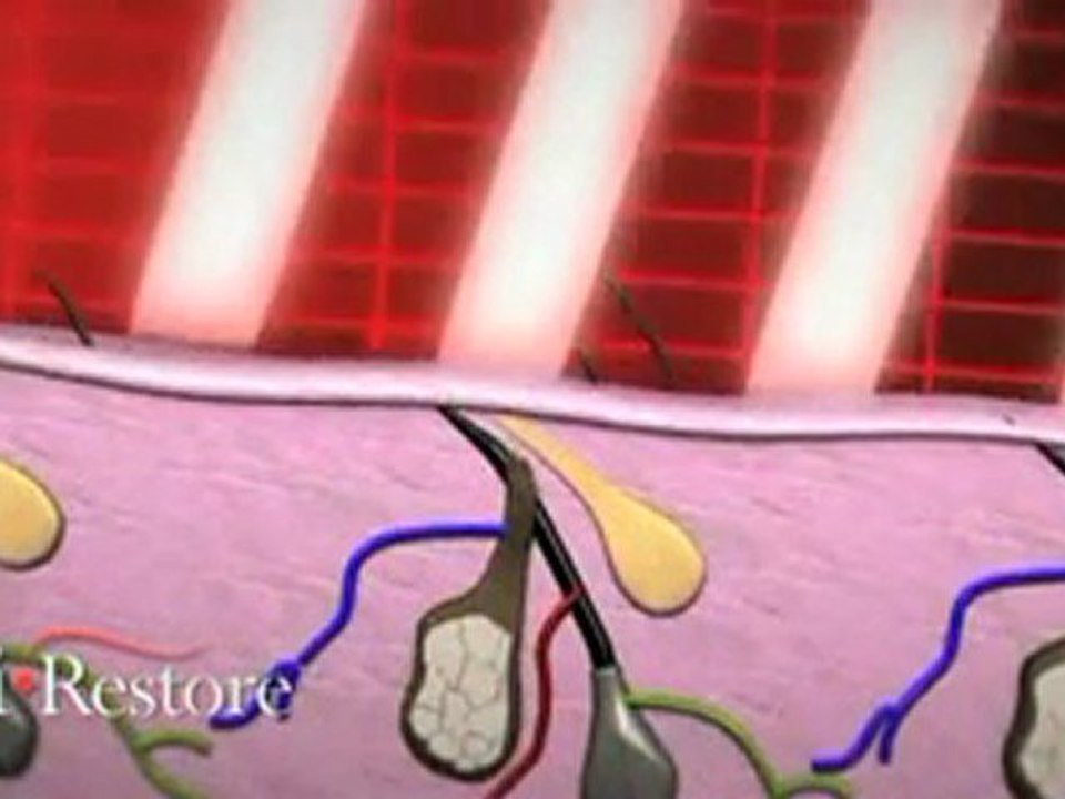 Laser Hair Therapy Treatment| laser hair loss treatment| control hair loss