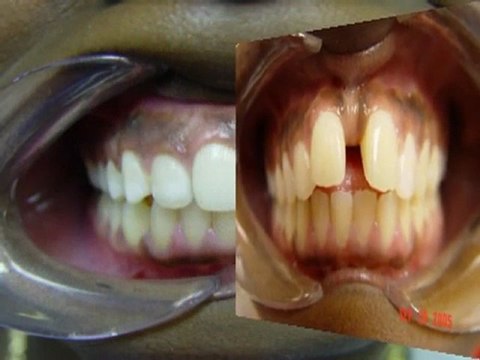 Invisalign Manhattan | Cosmetic Dentist Downtown NY | Dental Manhattan