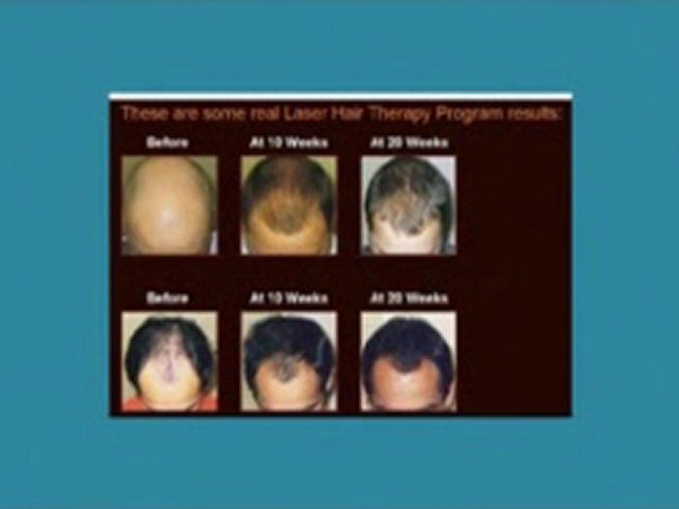 NEW iGrow Laser Hair Rejuventation