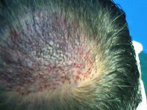 Hair Transplant Moscow / Hair Restoration in Moscow Russia