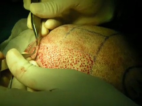 Hair Transplant Belgium ,Cheap FUE hair transplant Bruxelles -Belgium