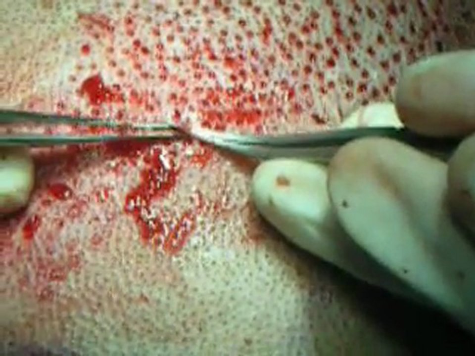 Cheap hair transplant (FUE) in Holland,Netherlands,Germany,France