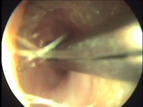 [Médecine] Chronic suppurative otitis media - Otite avec larve