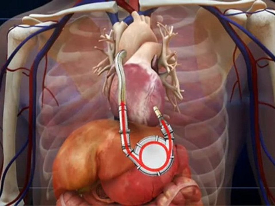 Dick Cheney gets heart pump fitted