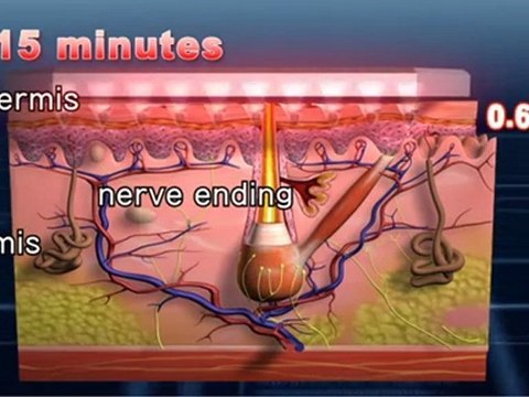 Vaccine patch takes the pain out of immunization