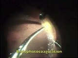 EVRS 2011 360º Giant Retinal Tear VILAPLANA