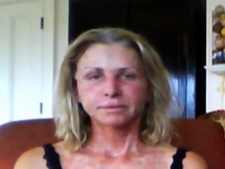 Boston Facelift Patient: 1 Day After Surgery