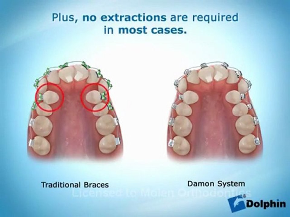 Fonctionnement Appareil Dentaire