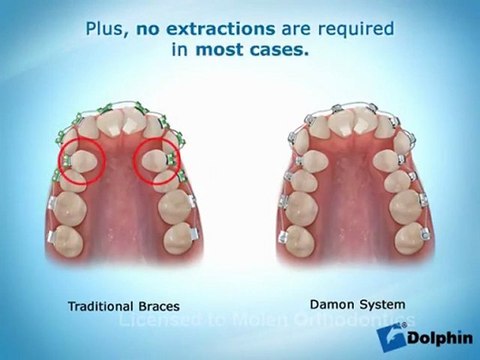 Fonctionnement Appareil Dentaire