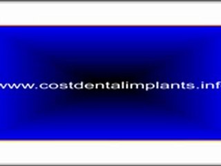 Finding The Best Prices For Dental Implants