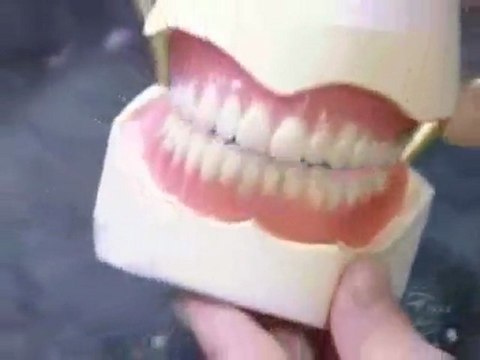 CCF (les prothèses dentaires)