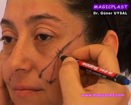 Op. Dr. Güner Uysal Yüz Estetiği Öncesi Planlama Sürecini Anlatıyor