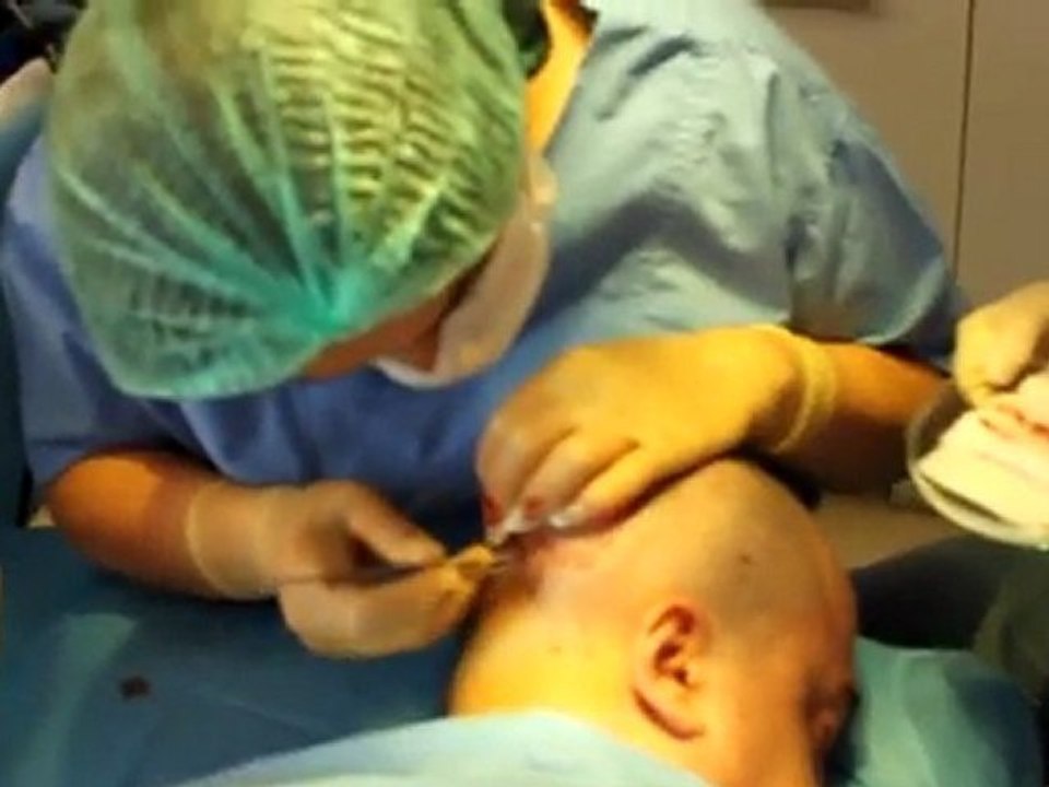 Saç Ekimi İşlemi Video