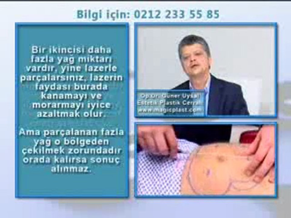 Star tv'de Op. Dr. Güner Uysal Lazer Lipoliz Tedavisini Anlatıyor