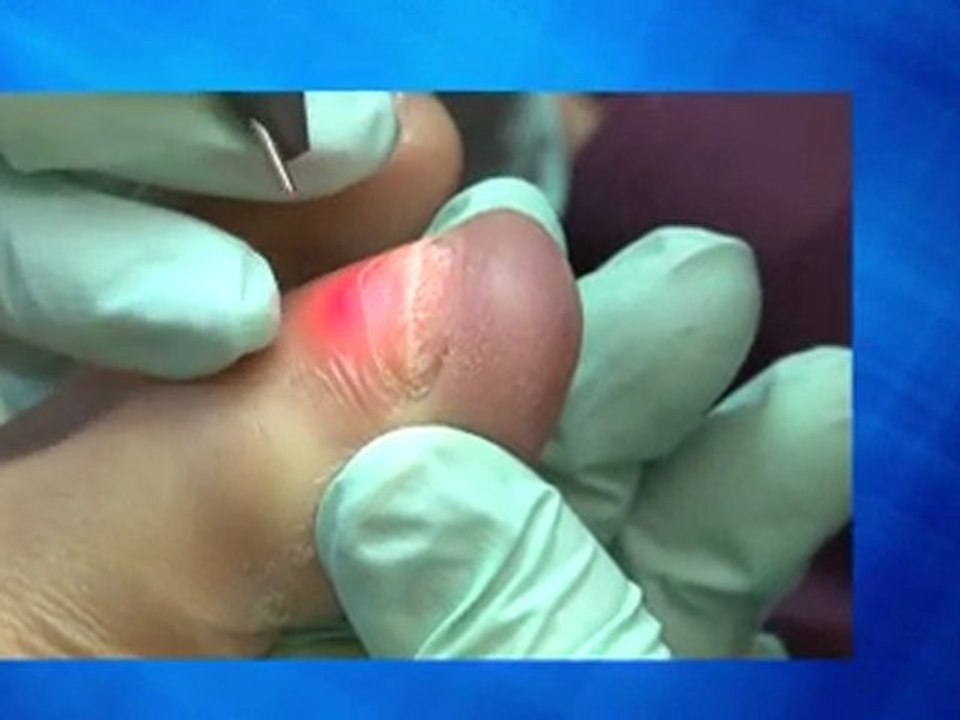 Laser Treatment for Toenail Fungus - Podiatrist in San Jose, CA