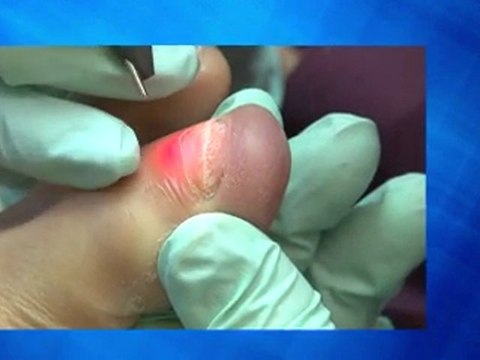 Laser Treatment for Toenail Fungus - Podiatrist in San Jose, CA