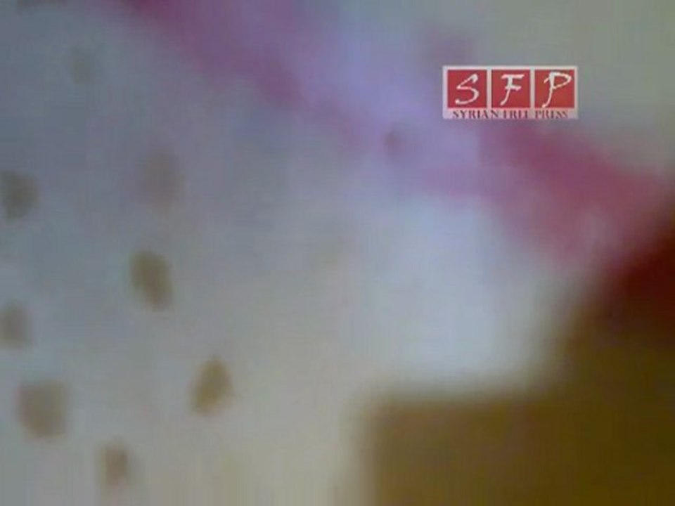 أثار التعذيب على جسد احد شباب المعضمية  الذي تعرض له من مليشيات لاسد وعصابته 11 8 2011