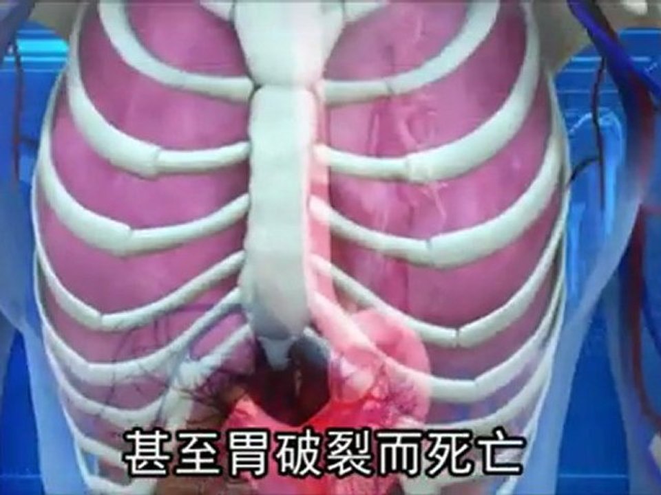 Woman nearly dies after stomach stretched to five times its normal size