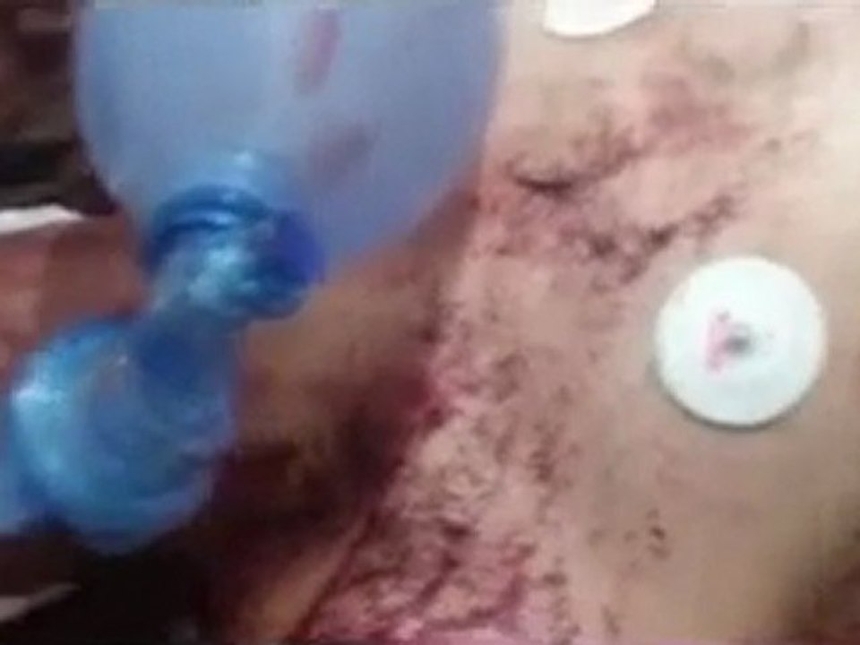 فري برس   حمص حي الخالدية جريح بحالة خطرة جدا جراء استهداف الحي بعد عصر اليوم من قبل عناصر الأمن والشبيحة 10 1 2012