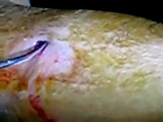 فري برس   اجراء جراحة لطفلة أصيبت بشظايا قذيفة في الزبداني 18 1 2012