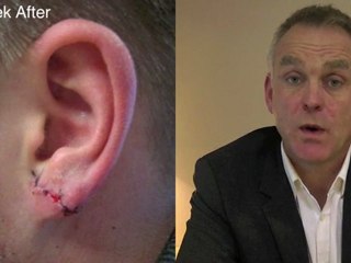 Tribal Earlobe Repair: How It's Done and What to Expect ✨