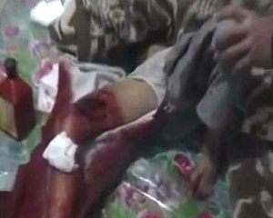 فري برس   حمص كرم الزيتون إصابة طفل في منطقة الفخذ بسبب إطلاق النار العشوائي من حواجز الامن 30 11 2011