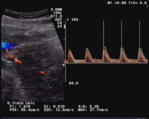 Aloka- Volvolo intestinale
