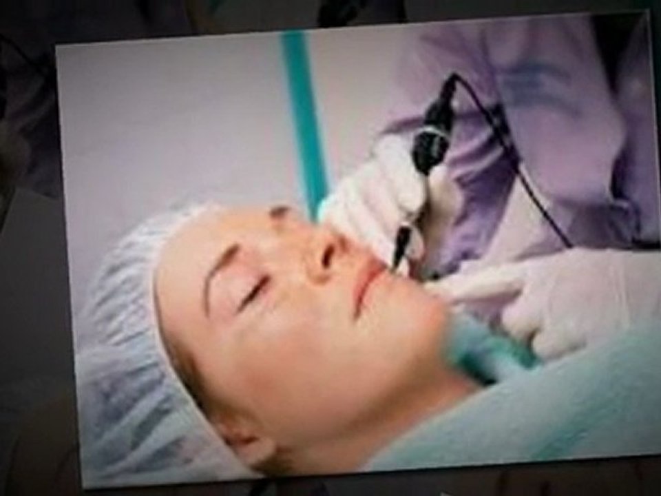 Say Bye to Acne Scars with Laser Acne Scar Removal