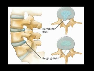 Best Sciatica Doctor in NYC Pain Treatment