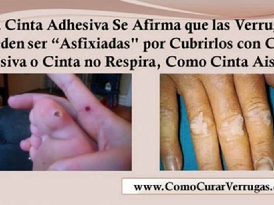 tratamiento de verrugas en el cuello