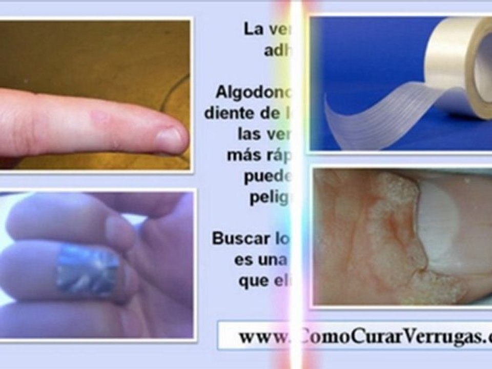 como se quitan las verrugas en el cuello