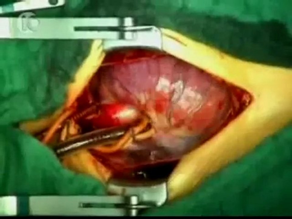 Artificial Heart