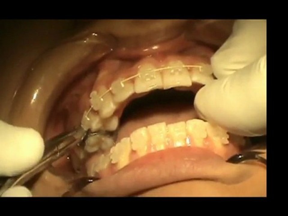 brackets ceramicos | brackets esteticos