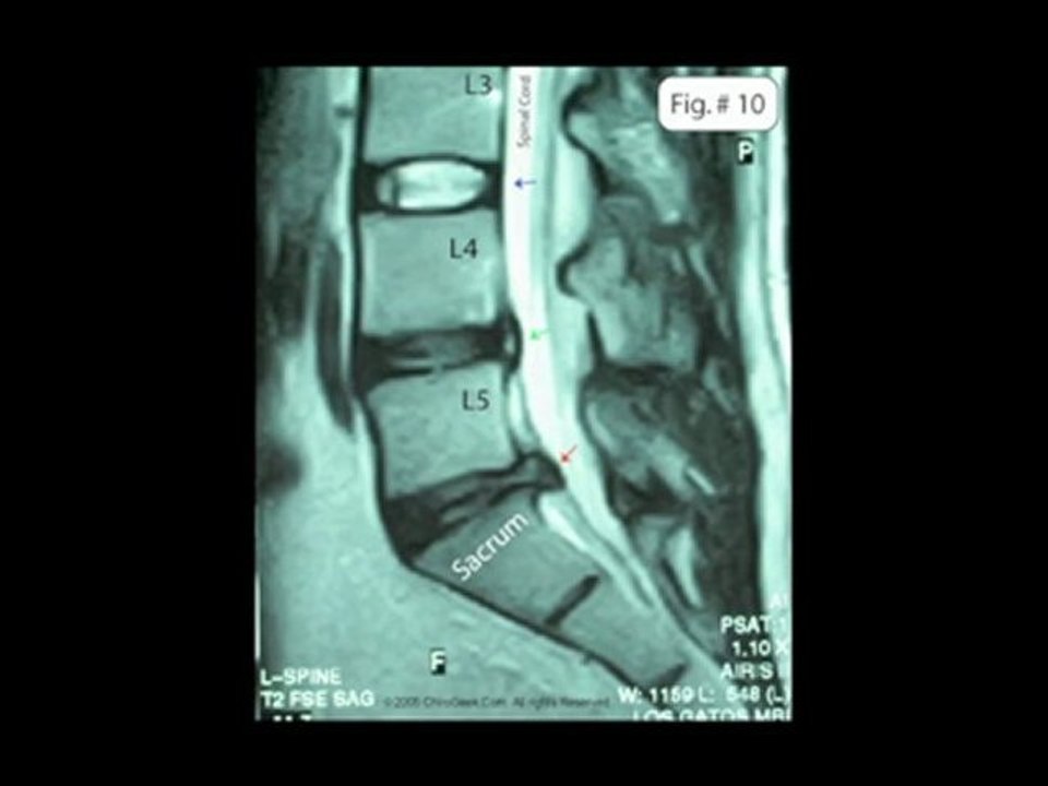 Stenosis Doctor NYC Manhattan Chiropractor Pain Treatment