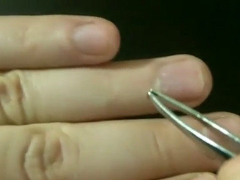 How to Get Rid of Hardened Scar Tissue