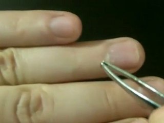 How to Get Rid of Hardened Scar Tissue