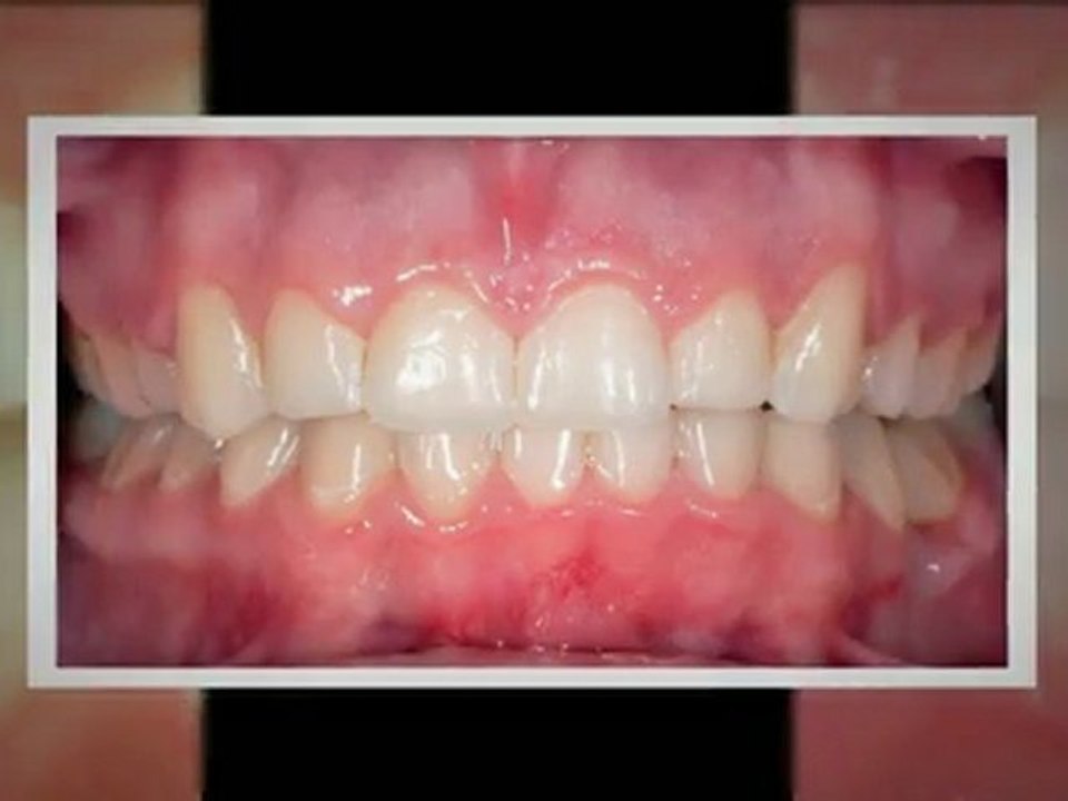 Braces Parker Jan2012