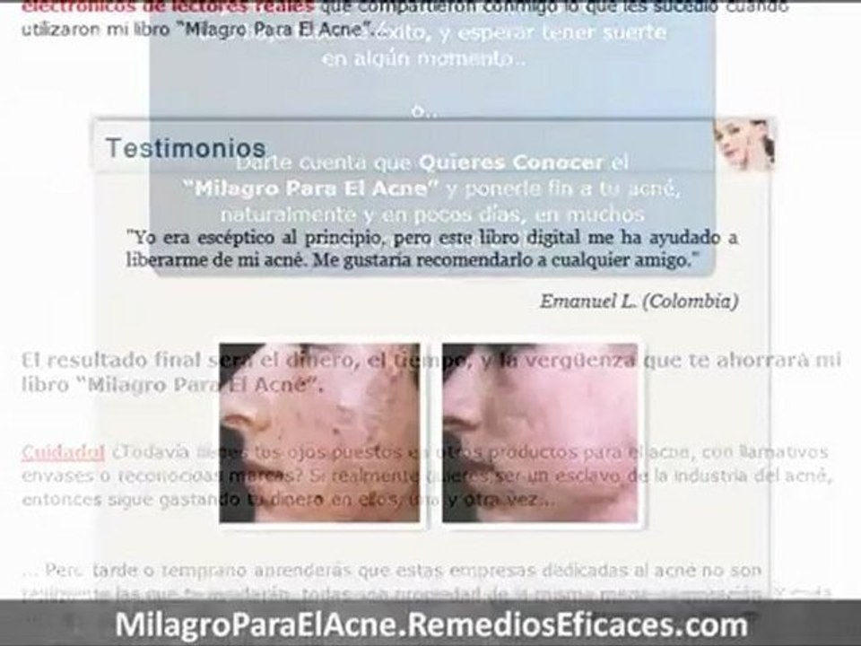 Como Quitar el Acne de la Cara - Como Eliminar las Espinillas