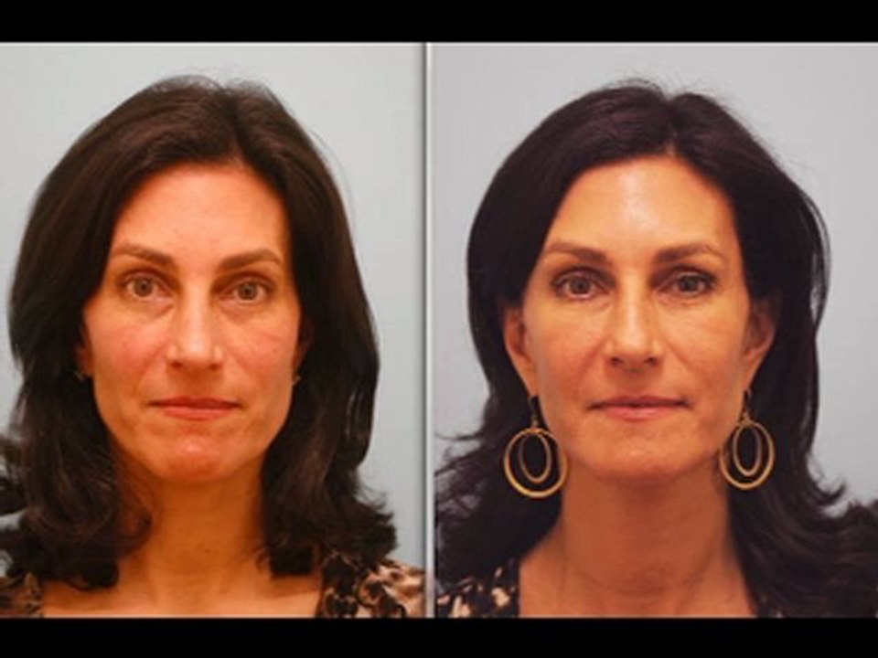 Fat Grafting Testimonial 2 Years Out (Make Up Removed on Both Images)