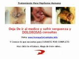 Verruga Genital Tratamiento, Quitar Verrugas Rapidamente