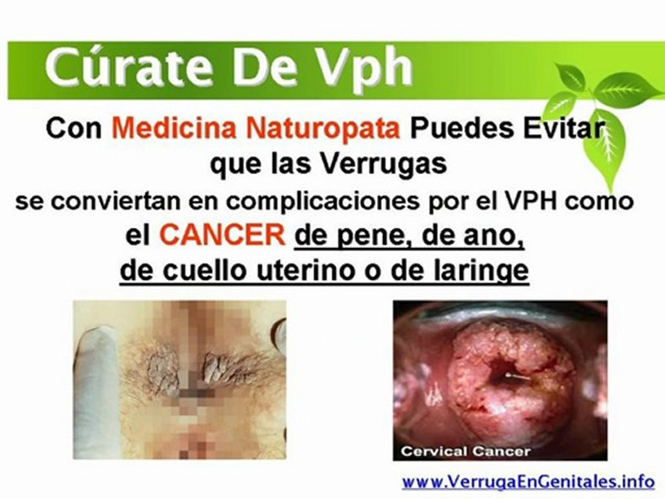 Como se eliminan verrugas genitales - Tratamiento natural para eliminar verrugas
