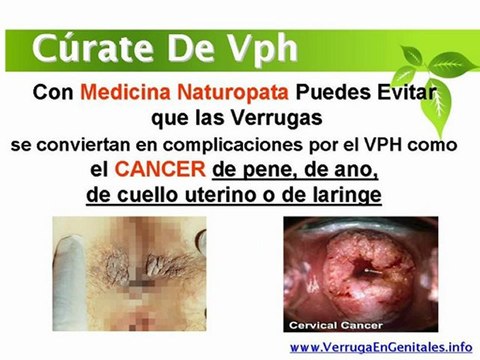Como se eliminan verrugas genitales - Tratamiento natural para eliminar verrugas