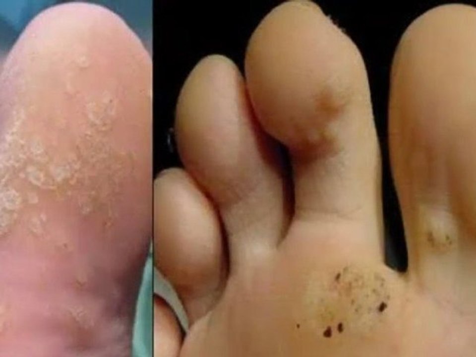 eliminar lunares rostro - eliminar los lunares - Como eliminar los lunares