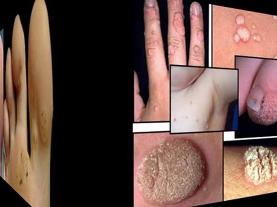 eliminar las verrugas - eliminación de lunares - como eliminar las verrugas