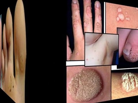 eliminar las verrugas - eliminación de lunares - como eliminar las verrugas