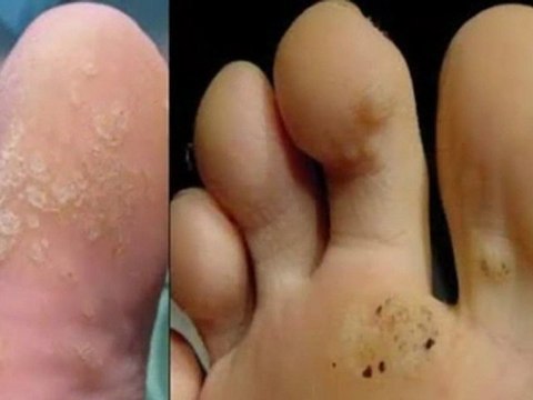 para eliminar las verrugas - tratamiento de las verrugas - remedio para las verrugas