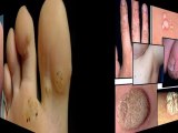 eliminar manchas acne - eliminar manchas rostro - quitar las manchas de la piel