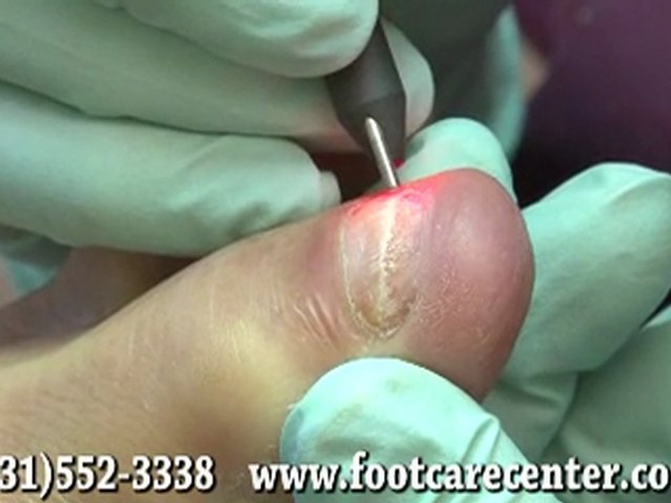 Laser Therapy for Fungal Toenails - Podiatrist in Clarksville, Springfield, TN and Hopkinsville, KY