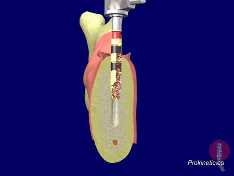 001 Implantes Dentales -Prokinetic - Quantum – Osteotomía