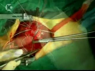 El pequeño Roí ya disfruta de su nuevo corazón artificial.